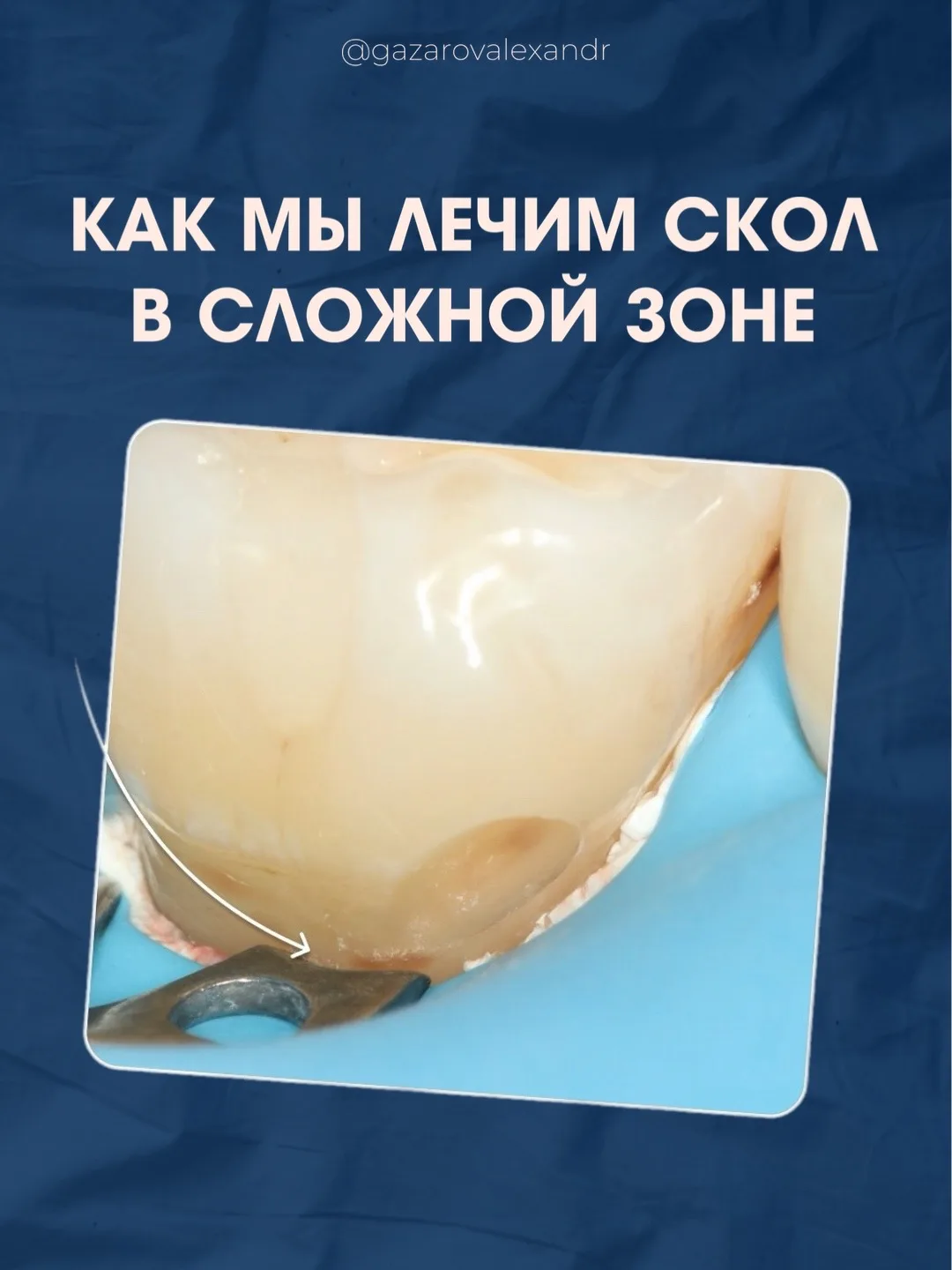 Один из самых трудных участков для лечения зубов — это зона около десны. Там постоянно ...