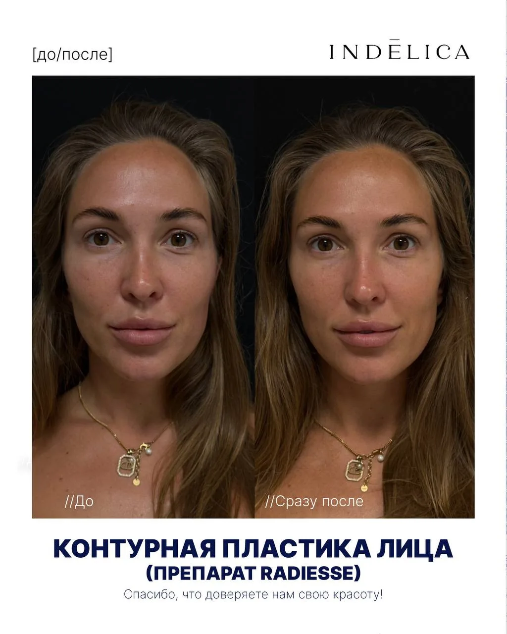 Скулы, овал, пропорции. Один препарат — сразу два эффекта 👆
