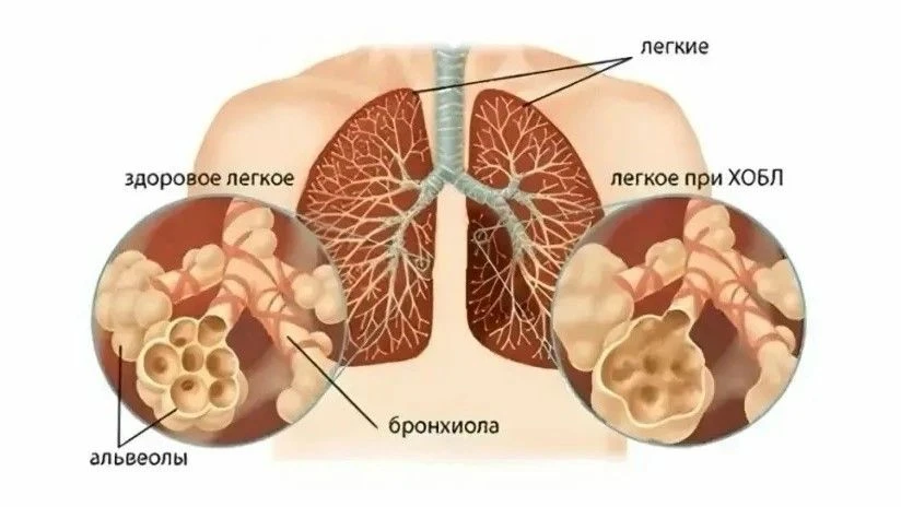 ХОБЛ и курение: как избежать опасной болезни

ХОБЛ — это хроническое воспалительное заболевание, при