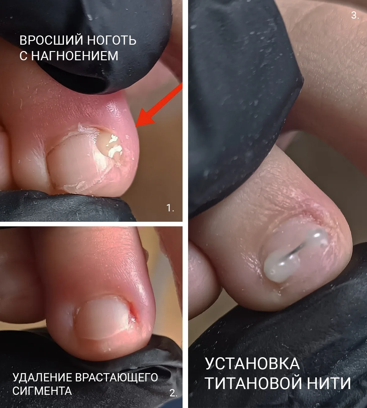 Почему появляется вросший ноготь?