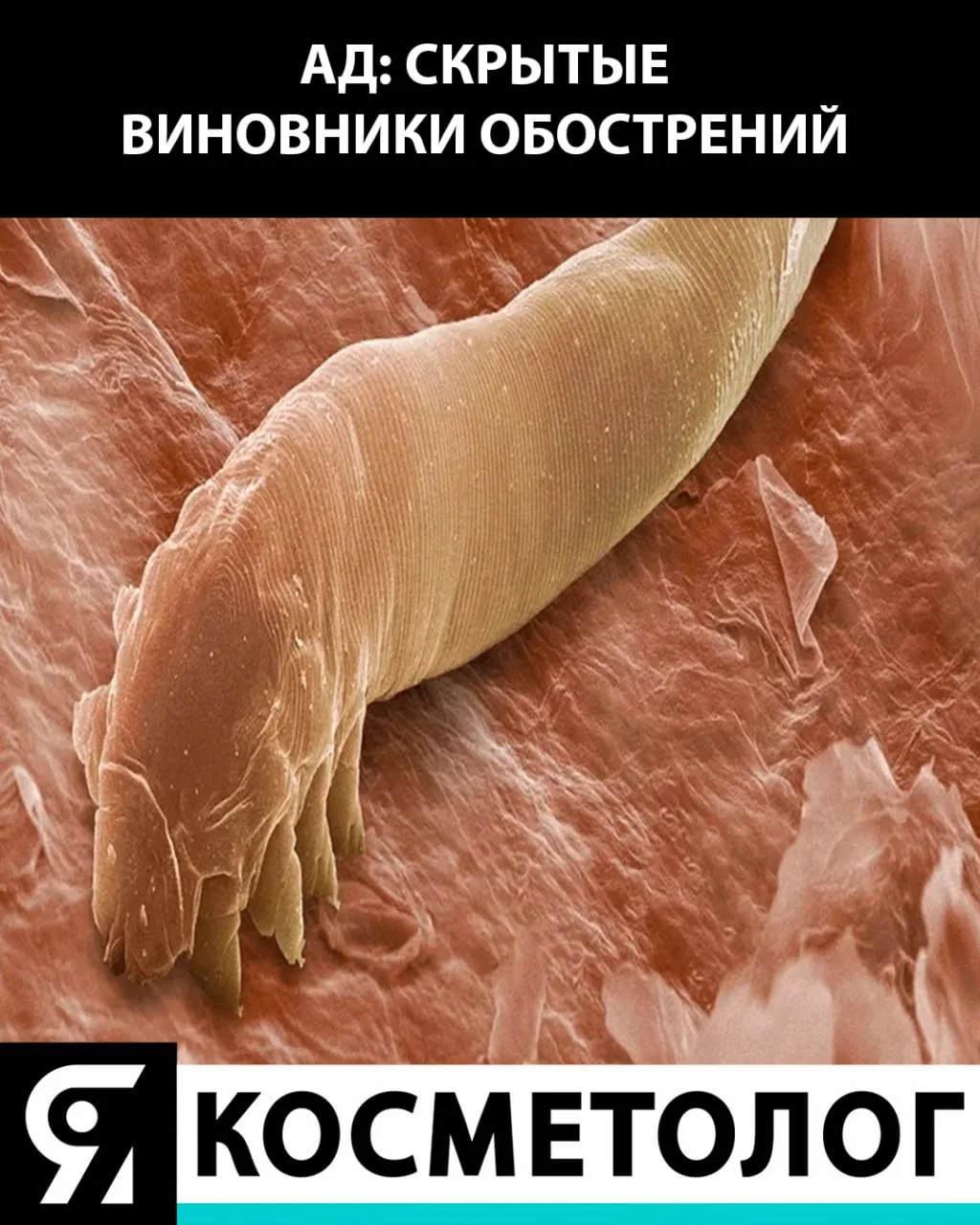Кожные грибы и клещи при атопическом дерматите