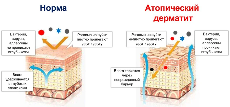 Уважаемые родители!

Среди вас наверняка найдутся те, чьи дети, к сожалению, страдают атопическим де