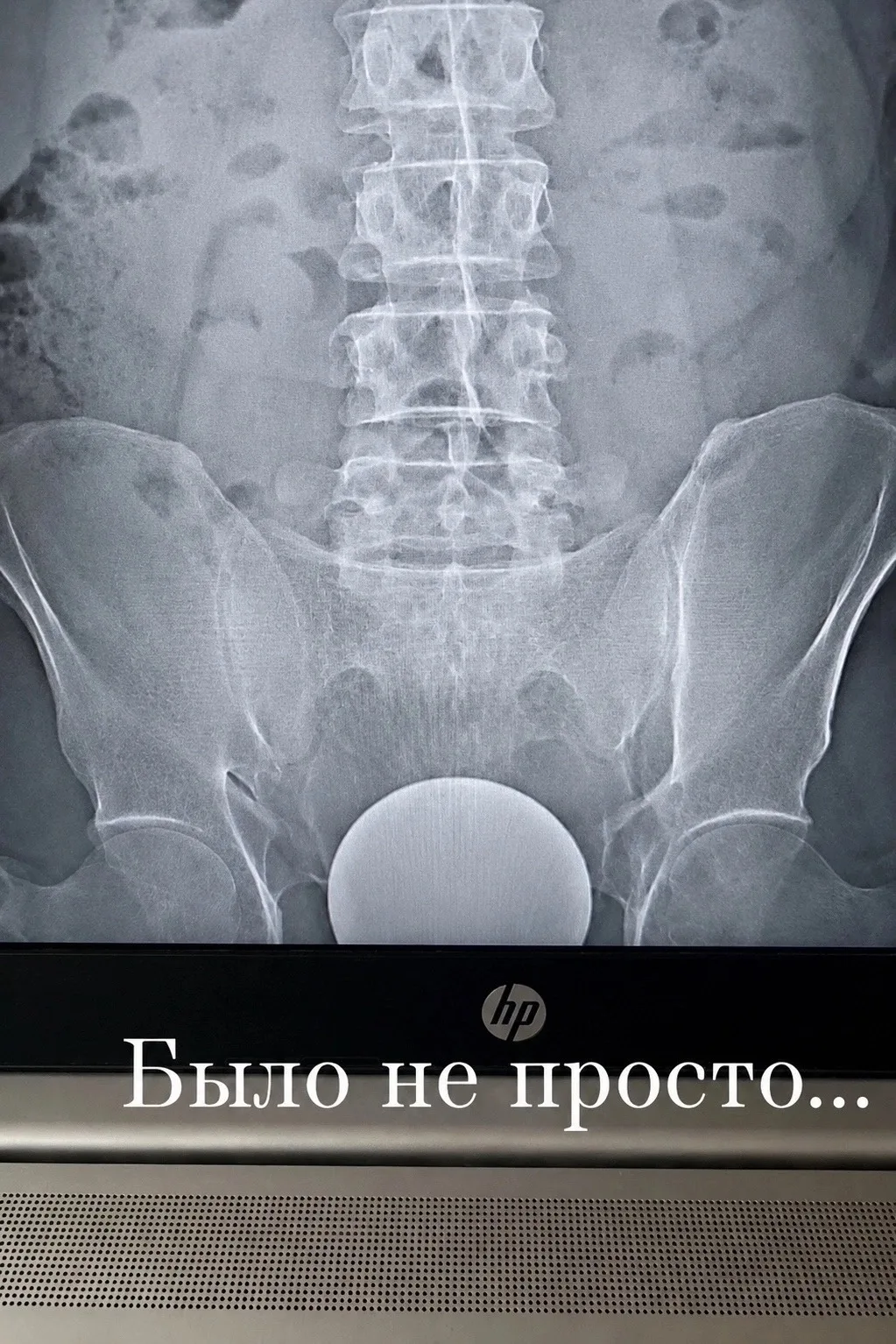 Парень попытался убедить врачей, что стеклянный шар диаметром 10😱 см телепортировался ...