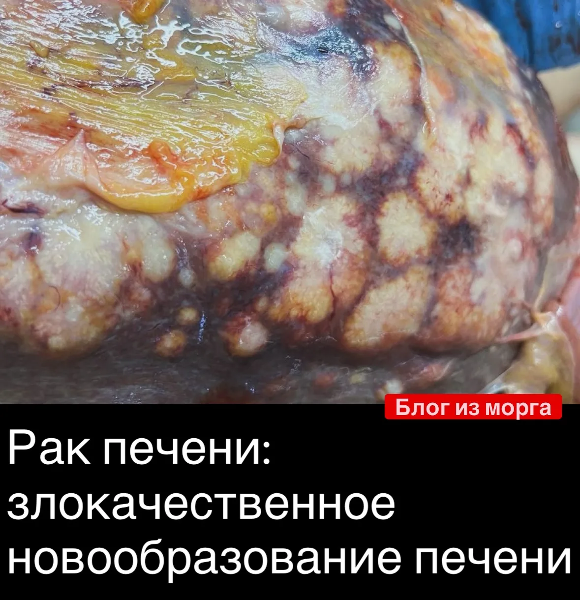 Злокачественное новообразование печени – это серьезная проблема. И самое неприятное то, что на ранни