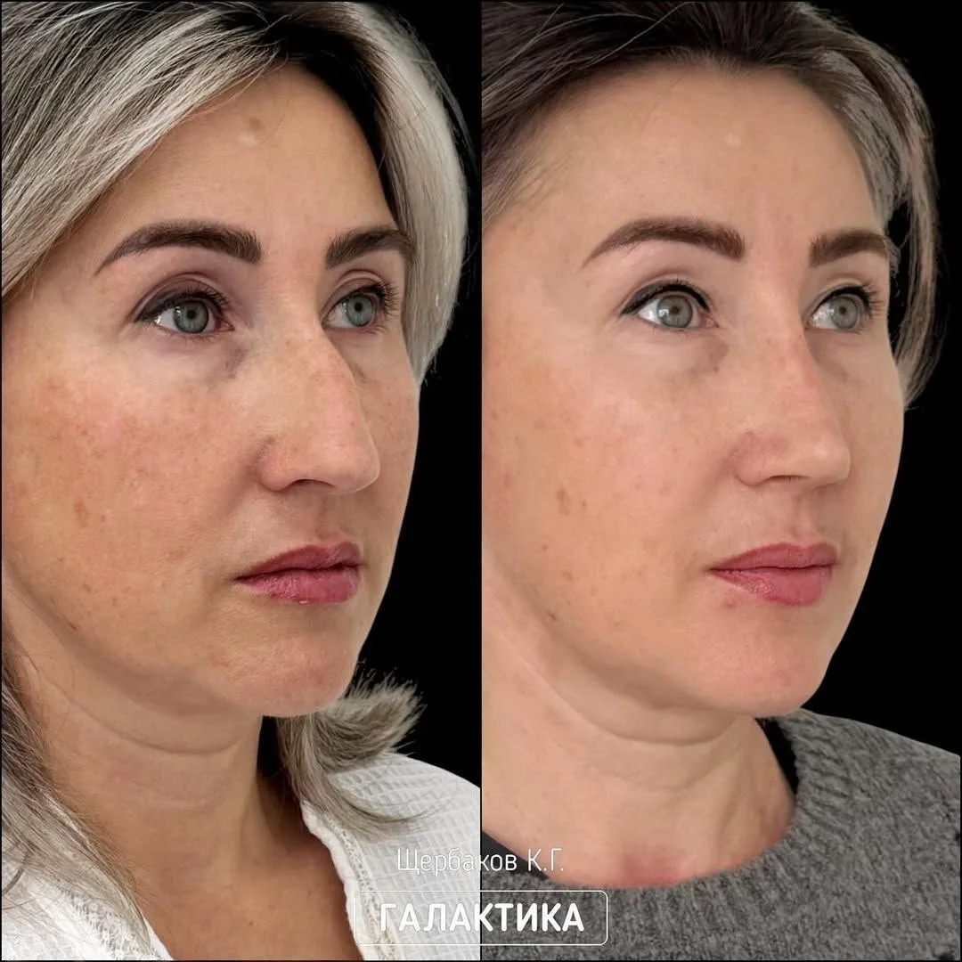 👃🏻 Горбинка ушла. Характер остался!