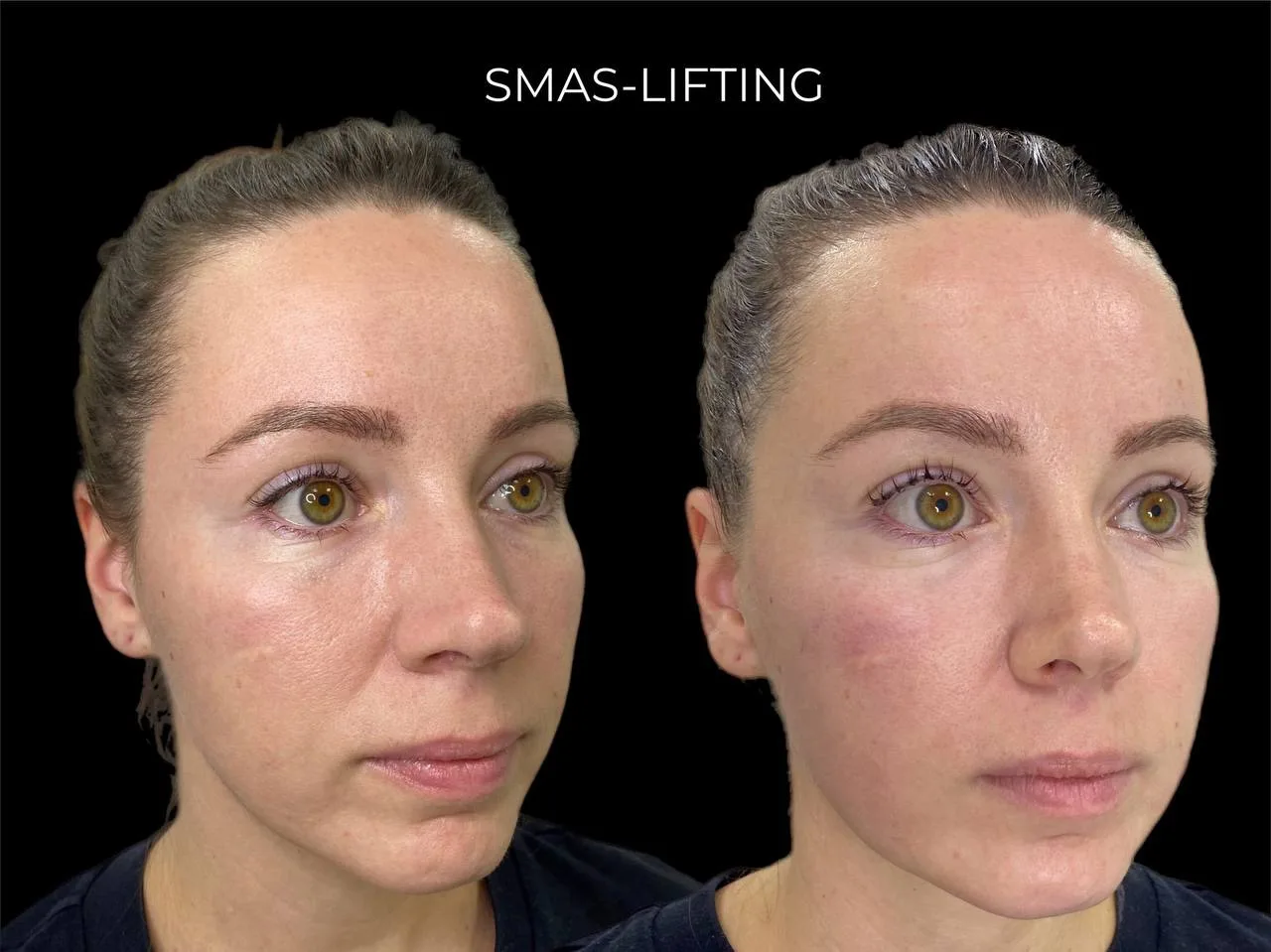 Эффект «мгновенной подтяжки» от процедуры SMAS-LIFTING.