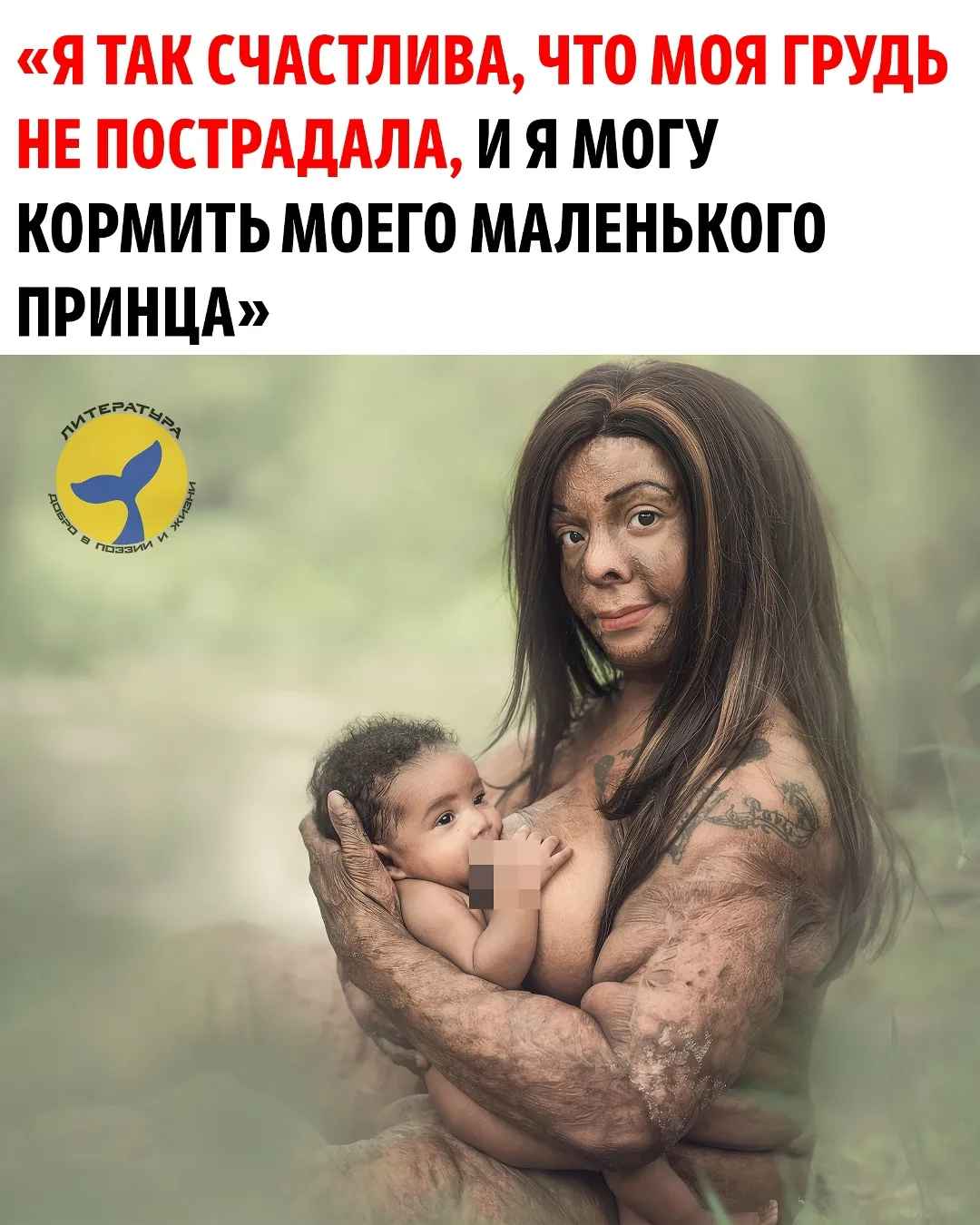 Фотография кормящей матери, пережившей ожог, покорила тысячи людей