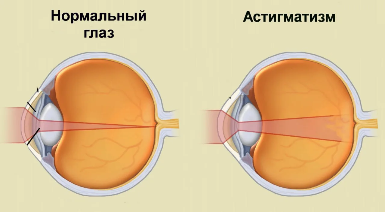 АСТИГМАТИЗМ, а, м. (спец.).