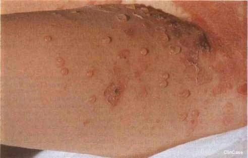 Буллезное импетиго: возбудитель — Staphylococcus aureus. Беспорядочно расположенные тон...