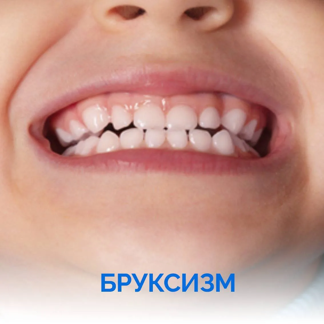Бруксизм 😬