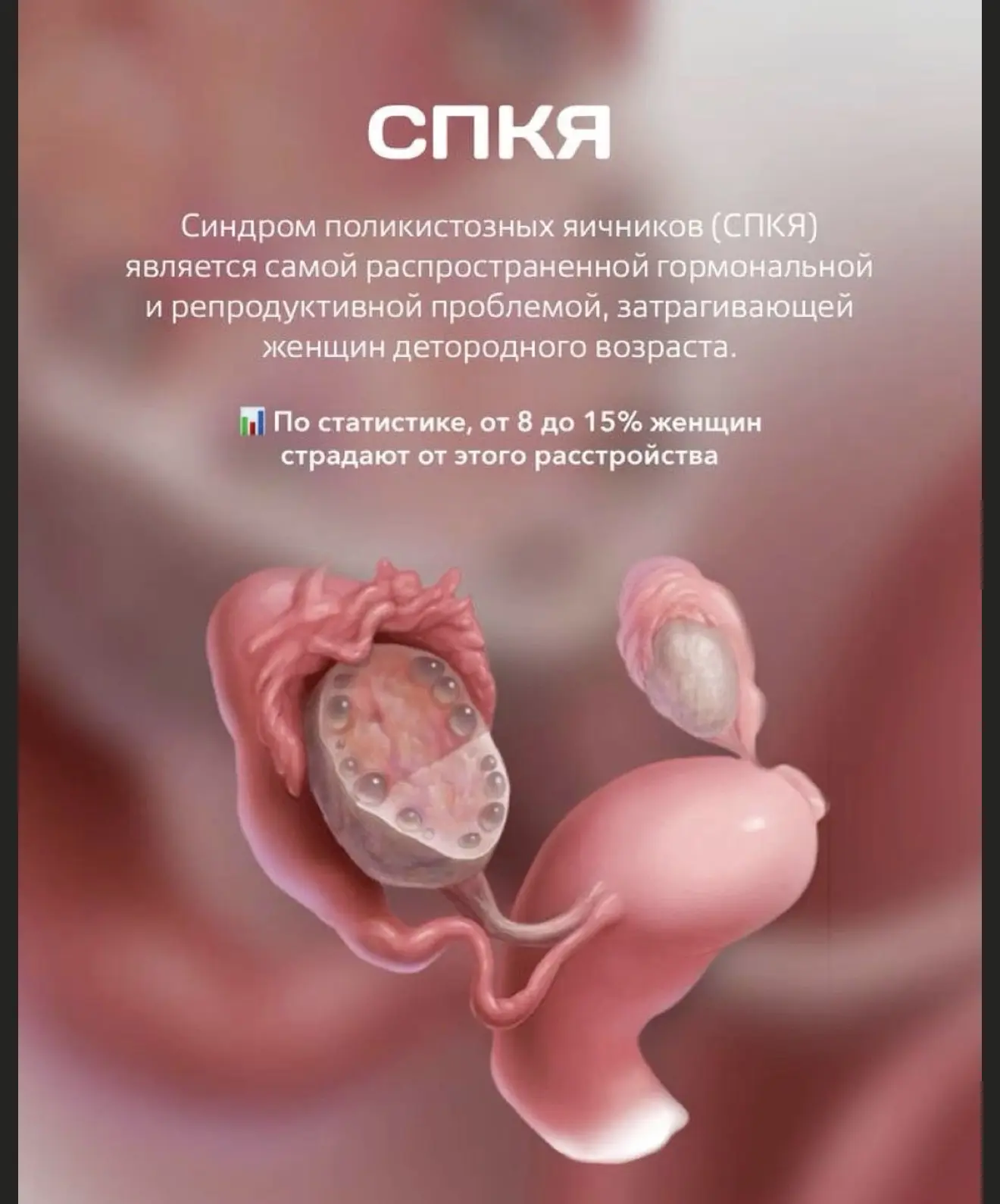 Одно из самых распространённых гормональных расстройств у женщин репродуктивного возраста — поликист