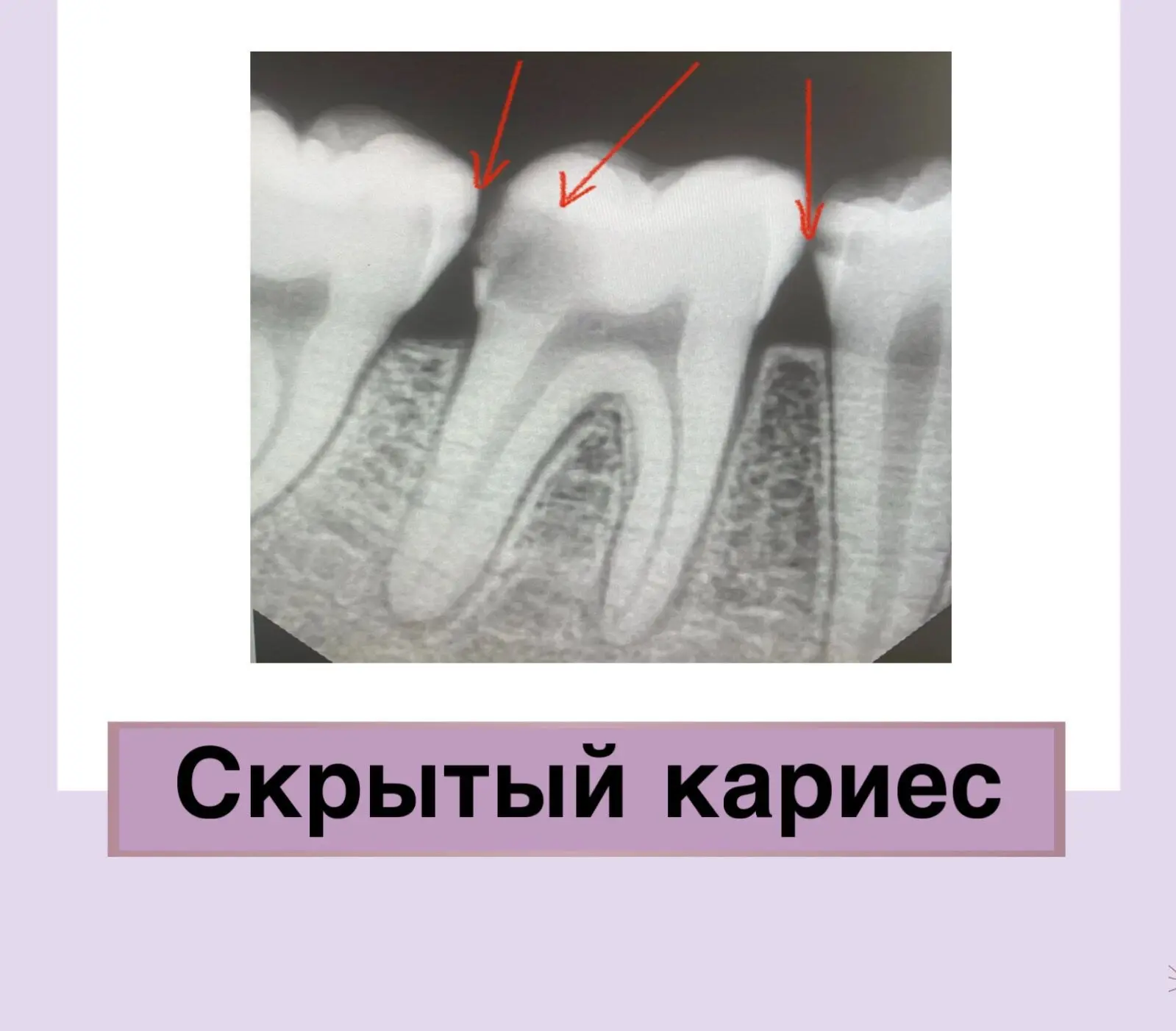 Скрытый кариес.