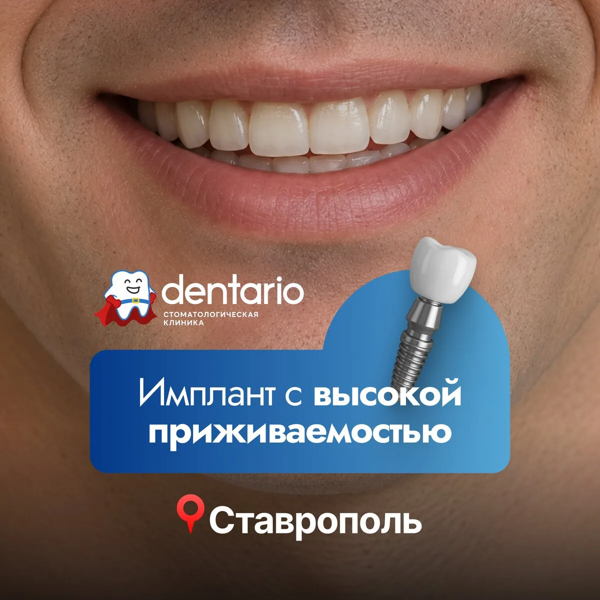 Зубной имплант с установкой от 22 500₽ в «Дентарио»