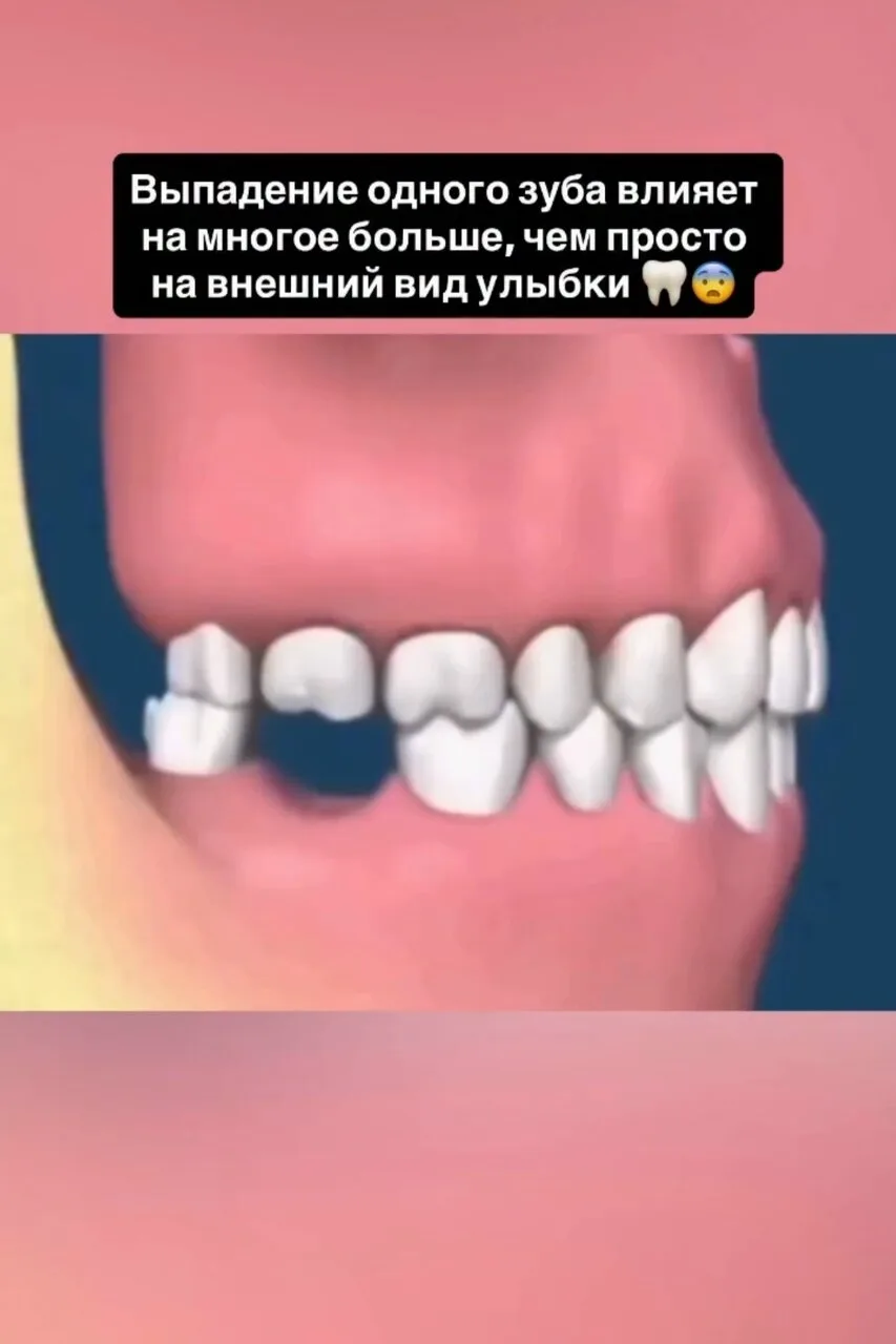 Потеря одного зуба — это не только вопрос улыбки.