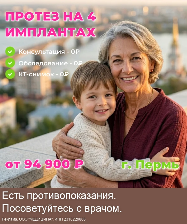 Несъёмное протезирование зубов на 4 имплантах в Перми.