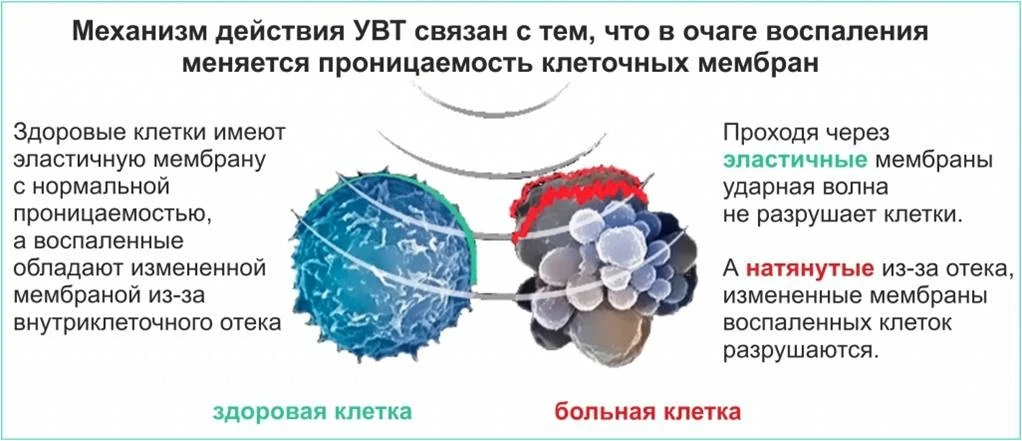 УДАРНО-ВОЛНОВАЯ ТЕРАПИЯ: новая формула для лечения хронической боли!