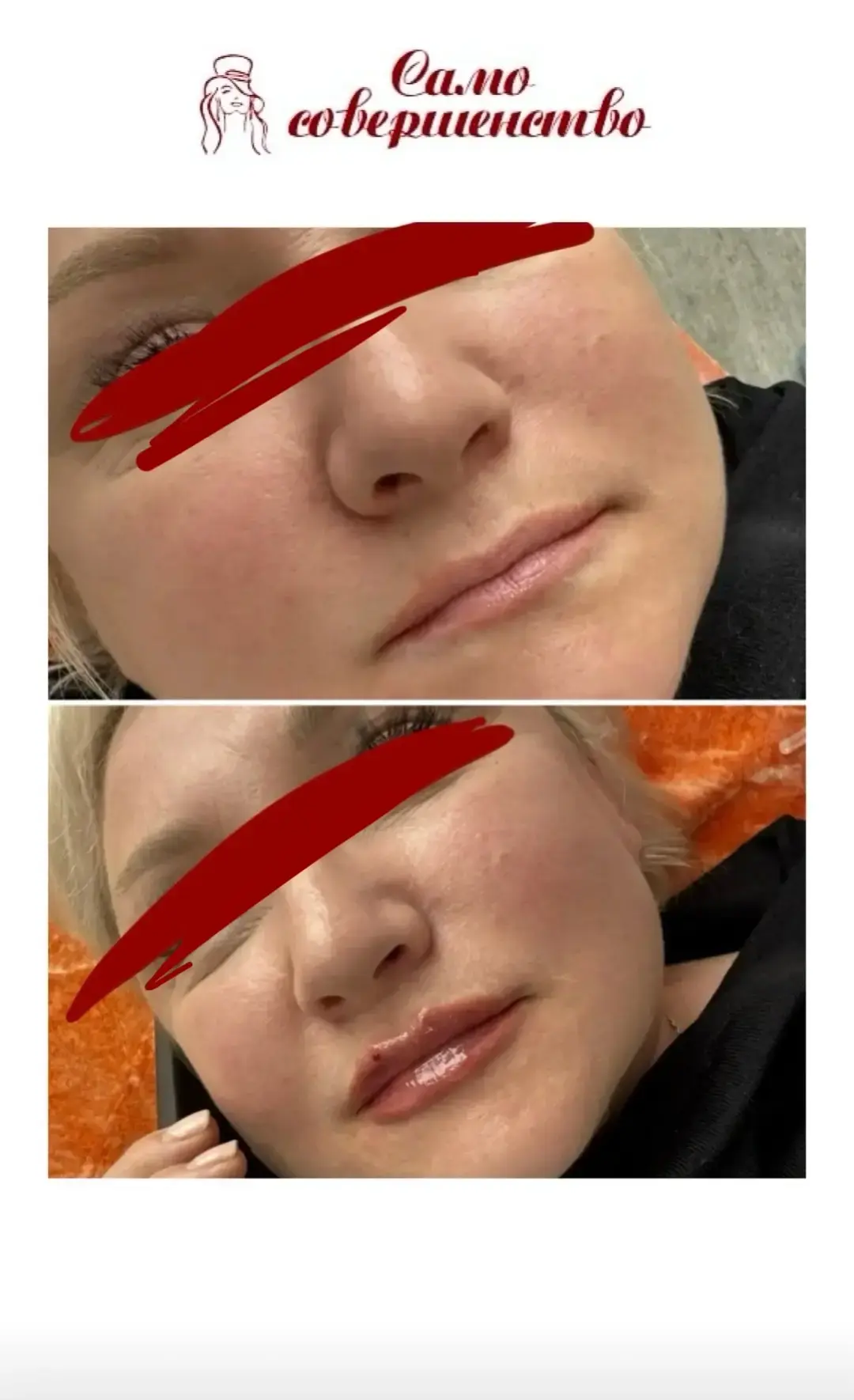 Хотите молодые, сочные губы, которые притягивают взгляды? ✨

Секрет прост: контурная пластика губ! В