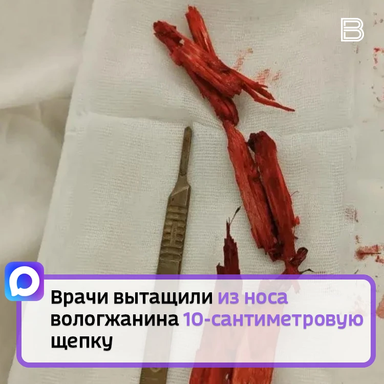 Тридцатилетний мужчина получил  производственную травму: в его носовой полости застряла деревянная щ