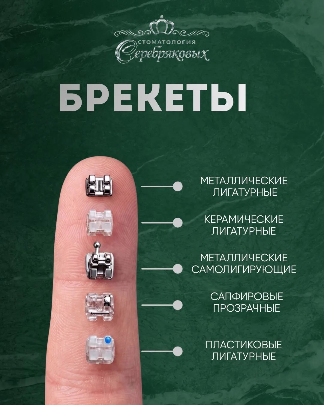 Какие брекеты ставят чаще всего в 2026 году? 🦷