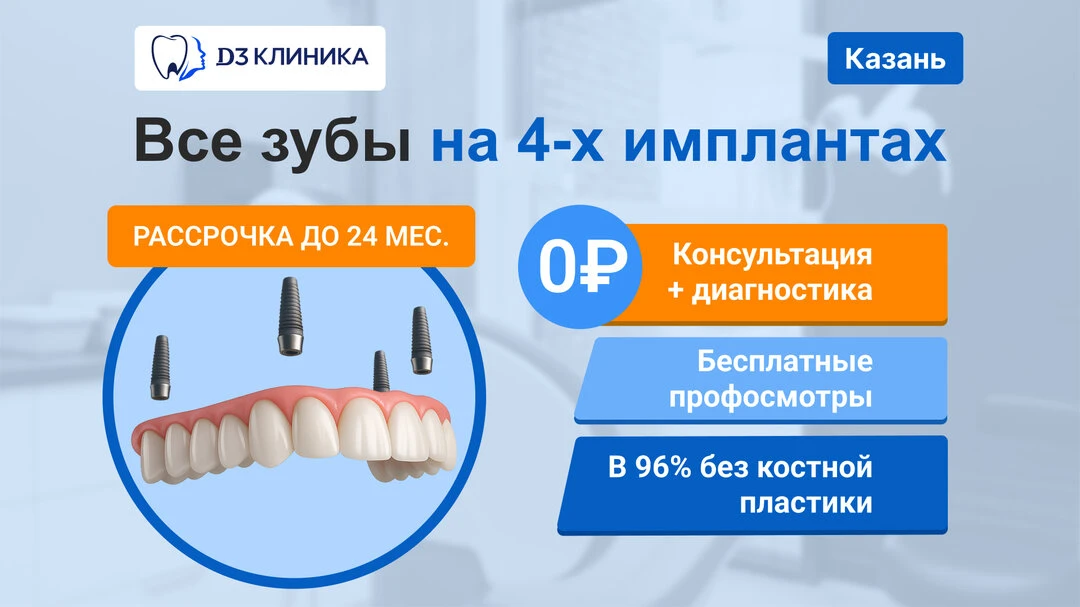 Несъёмное протезирование всей челюсти на 4-х имплантах