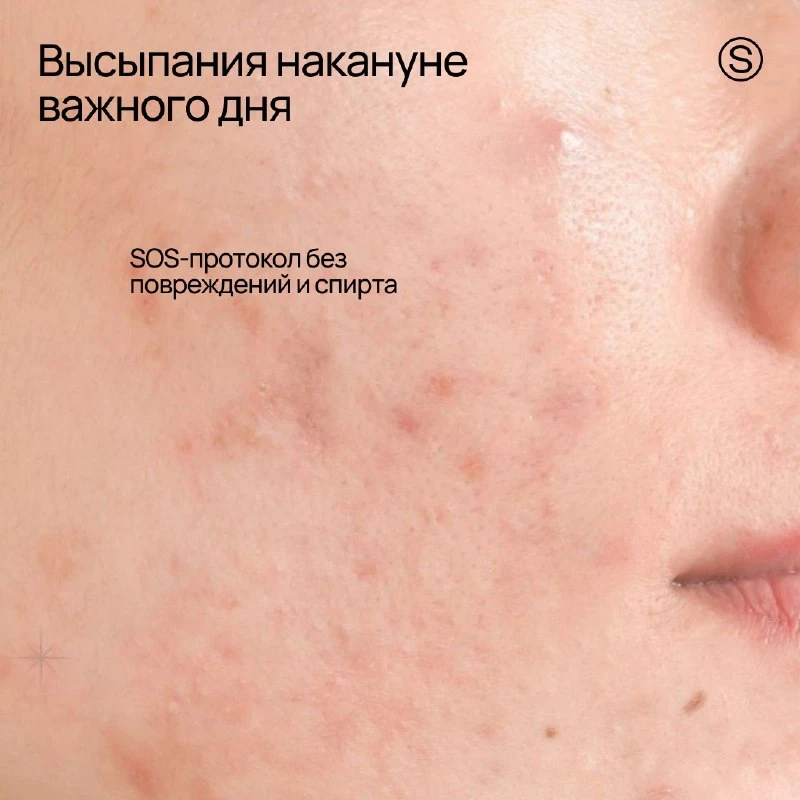 Перед важным событием кожа может реагировать на стресс, который запускает цепочку гормо...