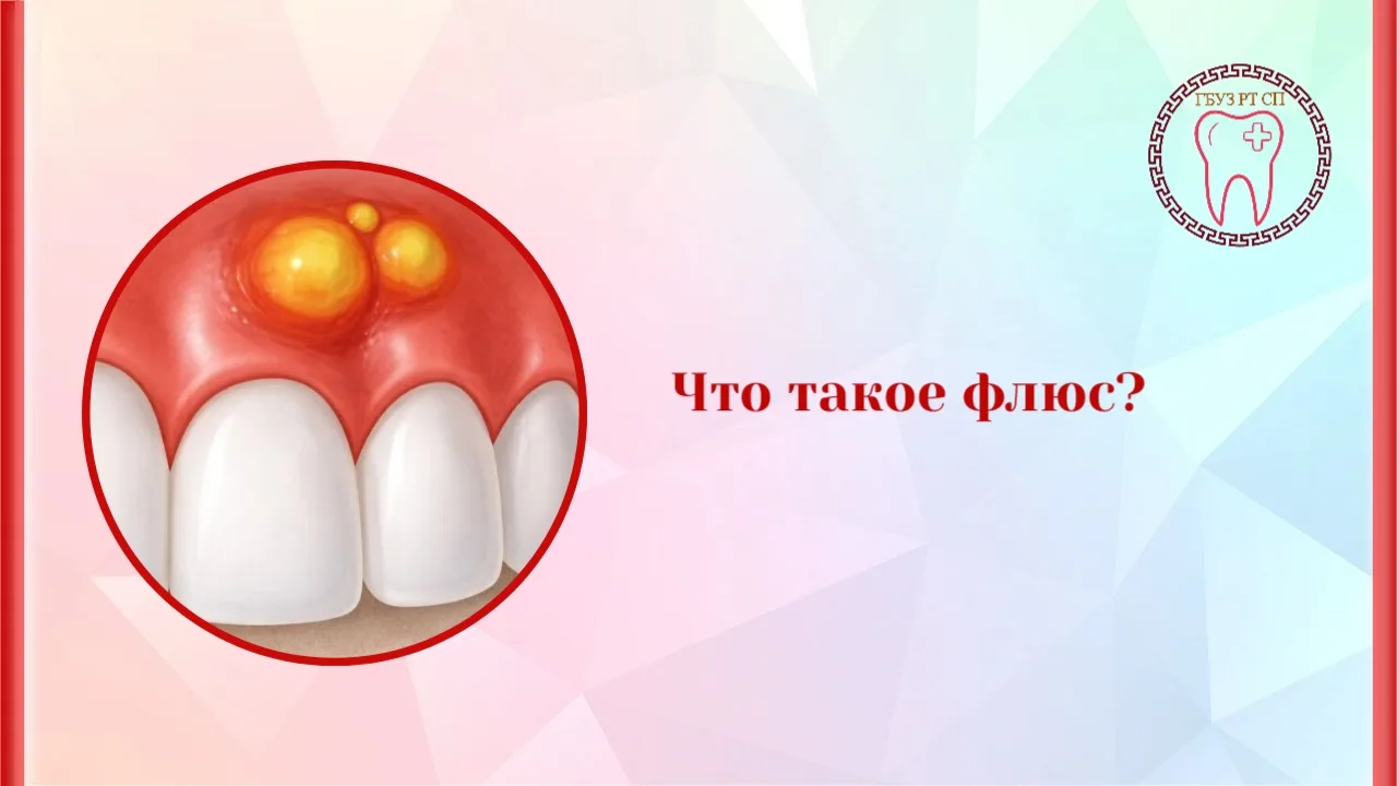 🦷 «Флюс» — это не просто опухшая щека. Что на самом деле происходит у вас во рту?

В народе «флюсом
