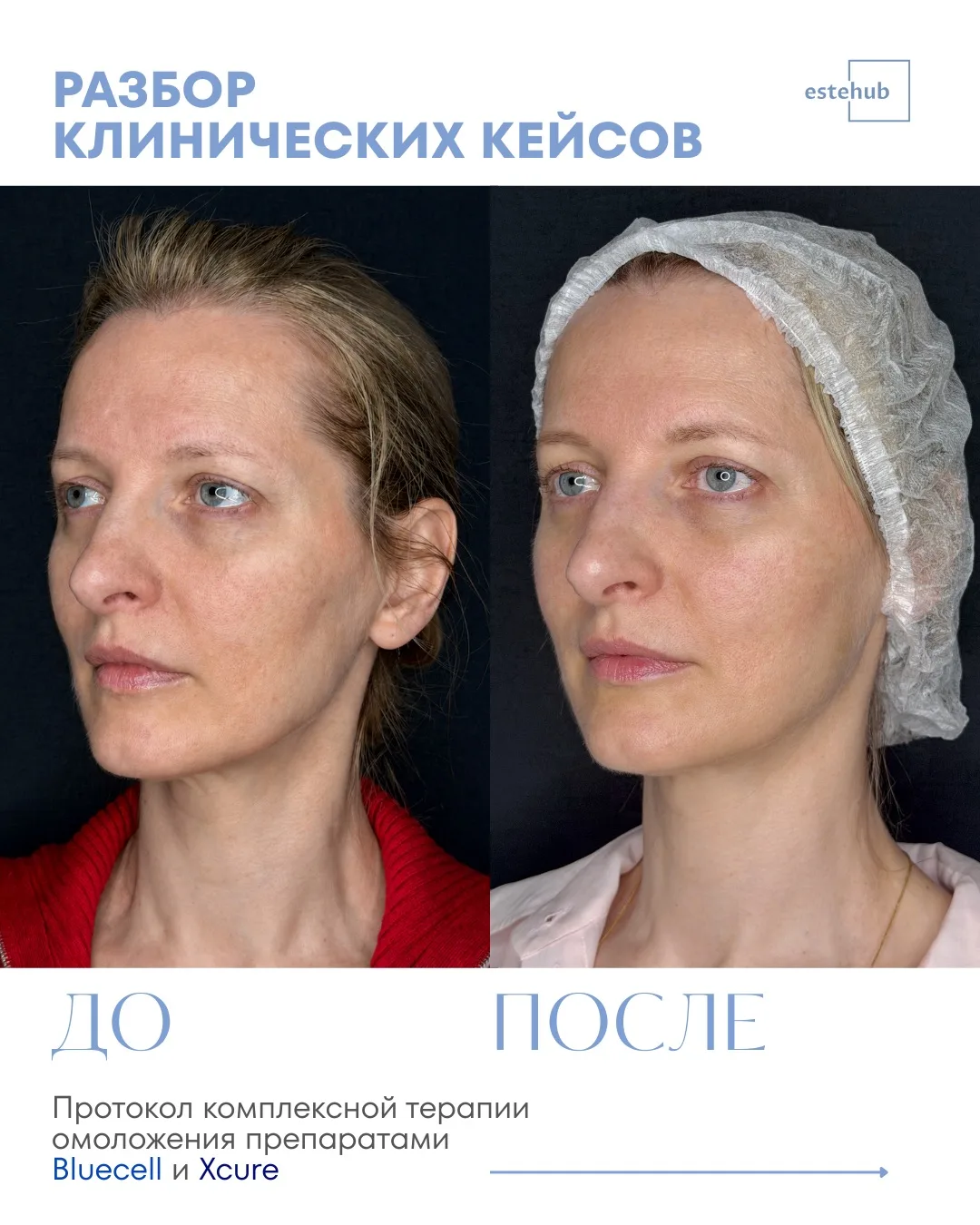 👩‍⚕️Клинический кейс: комплексное омоложение препаратами Bluecell и Xcure

В карусели разбираем реа