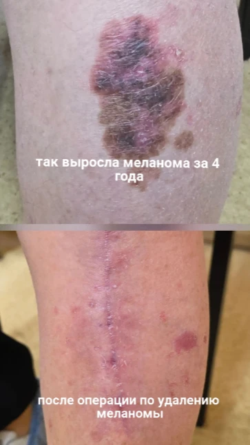 За медицинской помощью обратилась женщина 71 года с множественными высыпаниями на коже ног.
При осмо