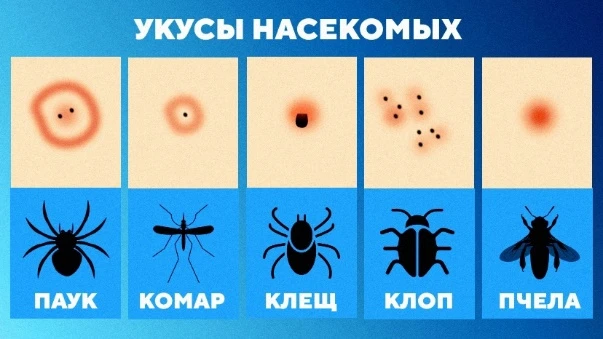 ➡️Укусы насекомых: симптомы, первая помощь и профилактика