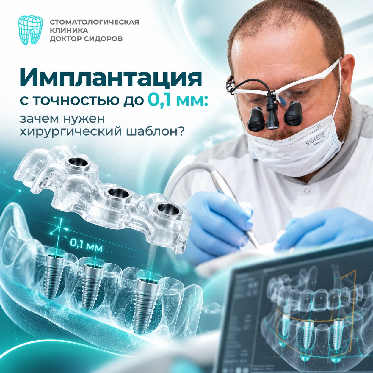 🦷 Имплантация с точностью до 0,1 мм: зачем нужен хирургический шаблон?