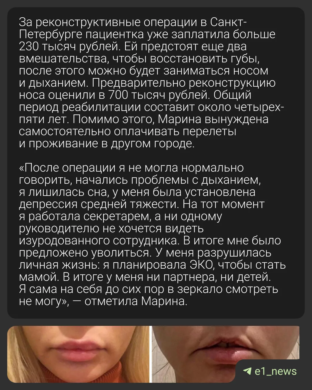 «Превратили в урода за 30 минут»  Екатеринбурженка обвинила известного хирурга в изуродованном лице.