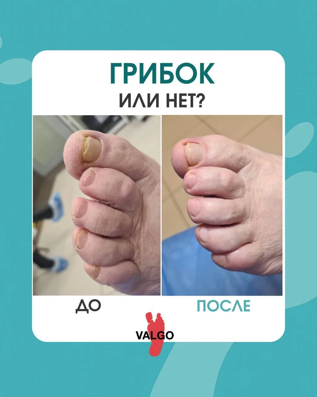 Грибок или нет❓