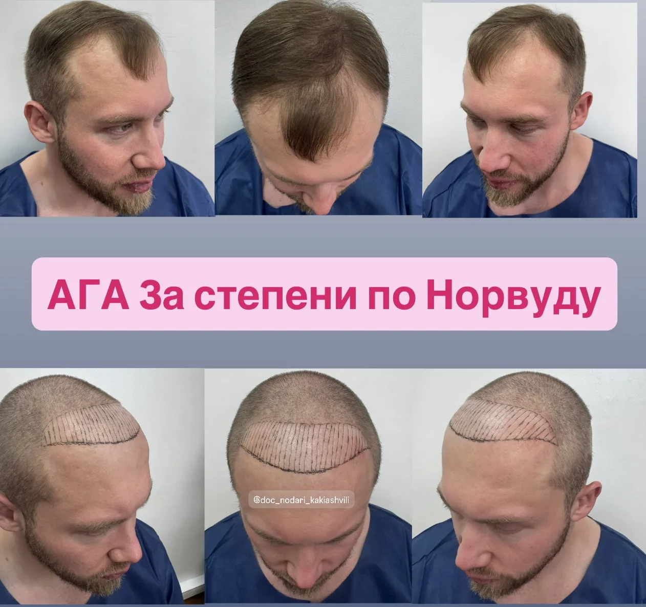 Исходная картина: будем восстанавливать лобную область. А далее, под наблюдением трихолога лечить те