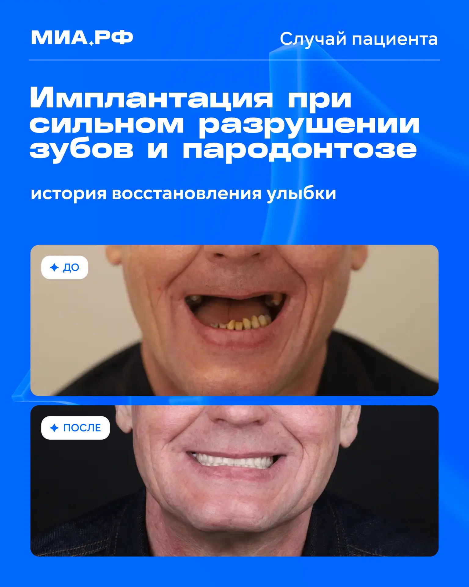 Разбираем случай пациента: как восстановить разрушенную улыбку?