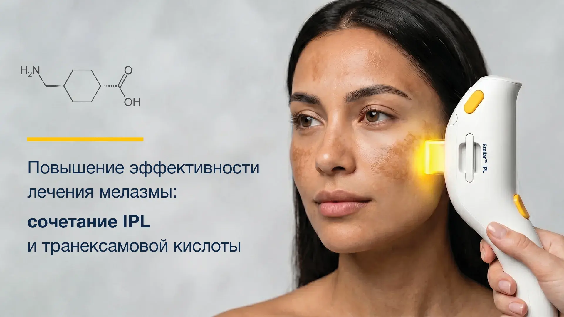 IPL + транексамовая кислота при мелазме: почему сочетанный подход может быть эффективнее