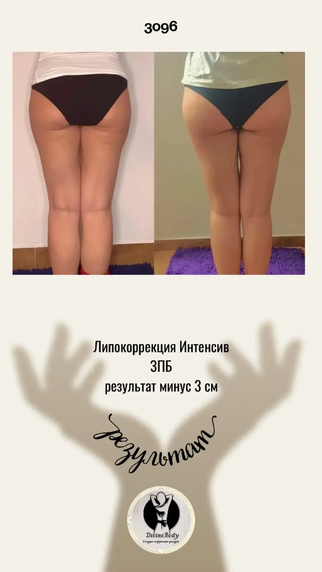 🔥 Минус 3 см в зоне задней поверхности бедра 🔥