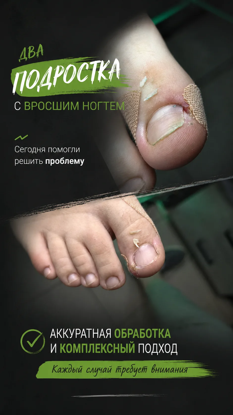 Сегодня взяли в работу сразу двух подростков с вросшим ногтем 👣