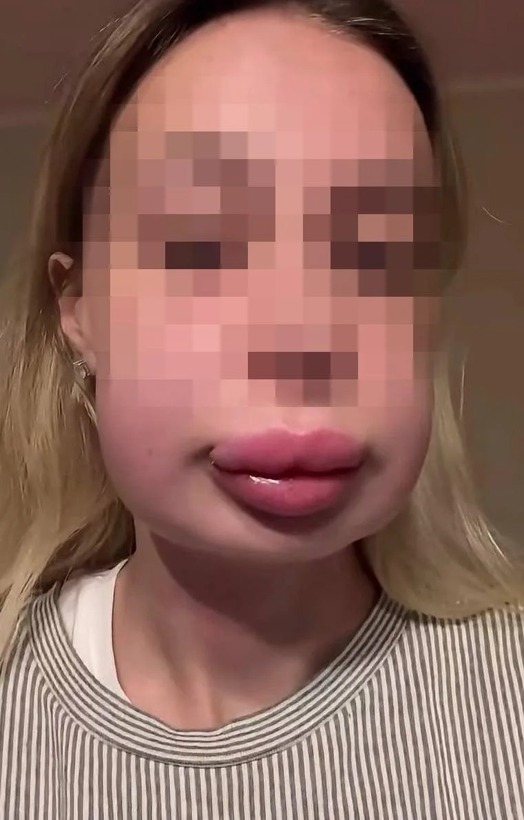 💋 Россиянка чуть не задохнулась и временно ослепла после попытки удалить филлеры из губ