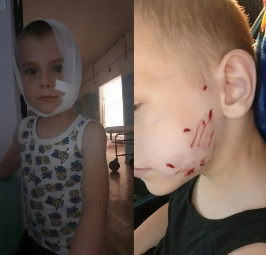 В соседнем Светлоярском районе бродячая собака изуродовала лицо 5-летнему ребёнку.

В поселке Привол