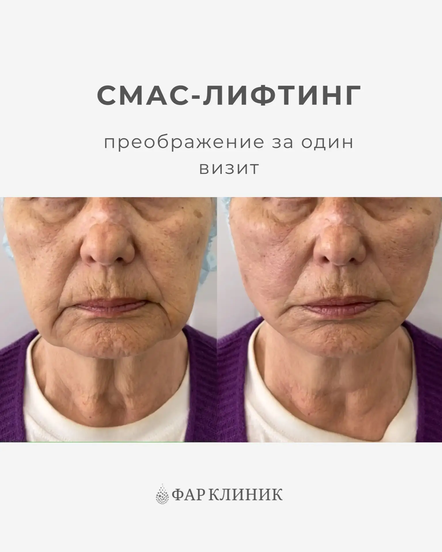 Лифтинг без операции - это не миф.