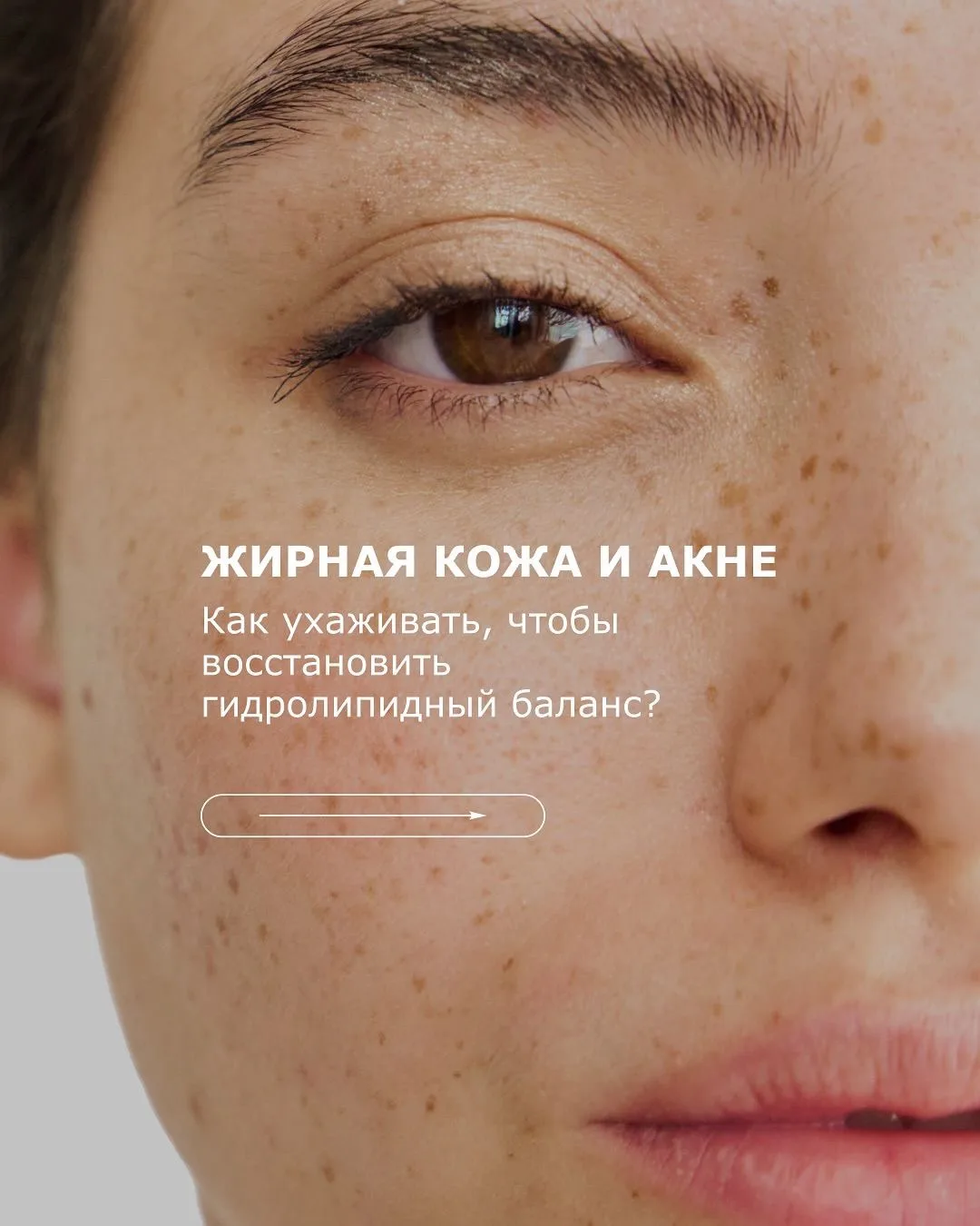 Жирная кожа и акне: как восстановить гидролипидный баланс?

Многие думают, что жирную кожу нужно пос