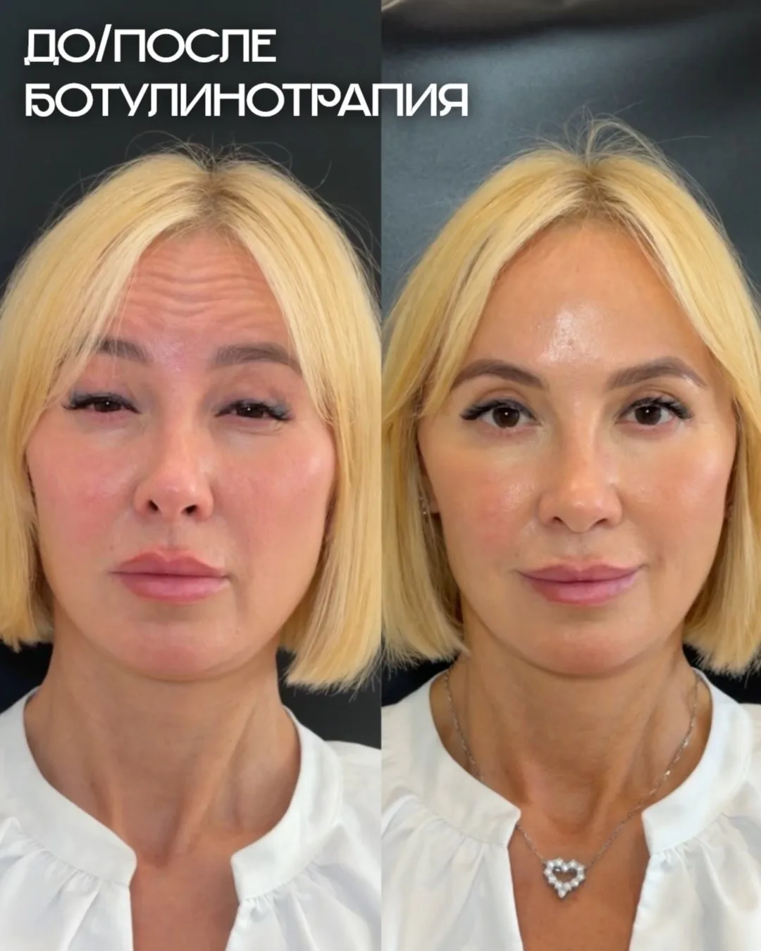 Ботулинотерапия. До/после.