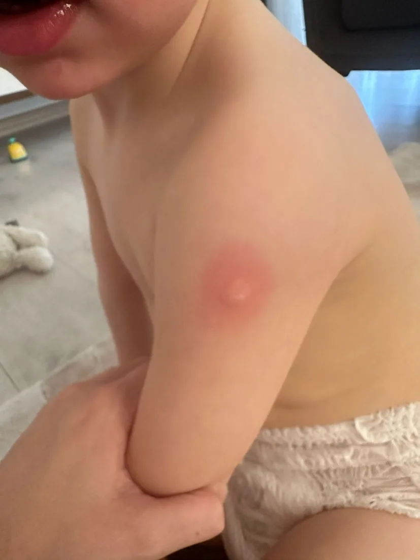 Реактивация рубца БЦЖ при гриппе: когда это не болезнь Кавасаки