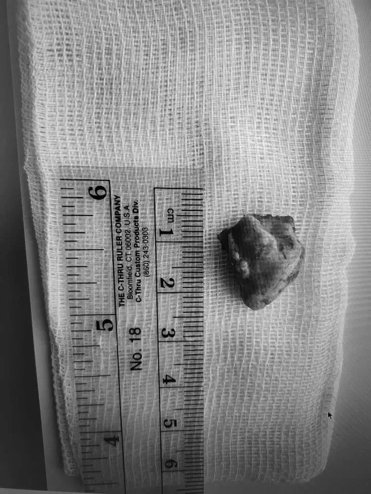 🦷Воронежские врачи удалили подростку аномально расположенный зачаток зуба