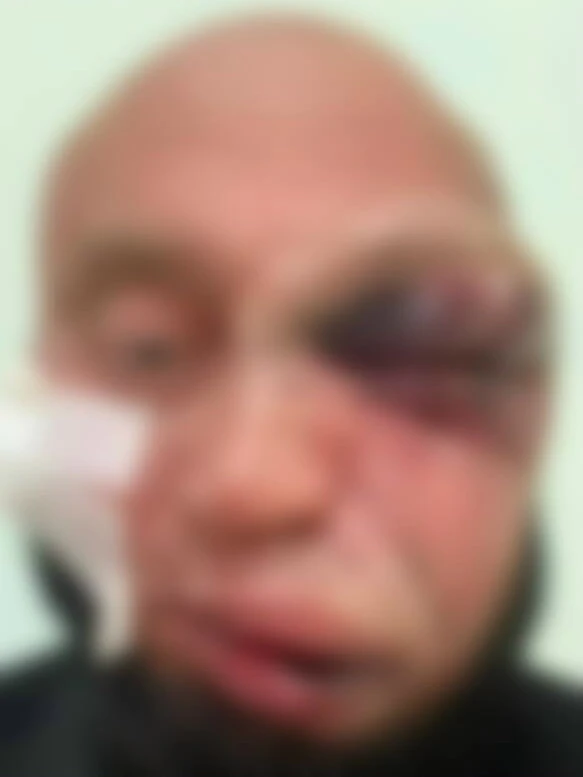Мужчине потребовалась трепанация черепа после жестокой драки у бара в Новосибирске