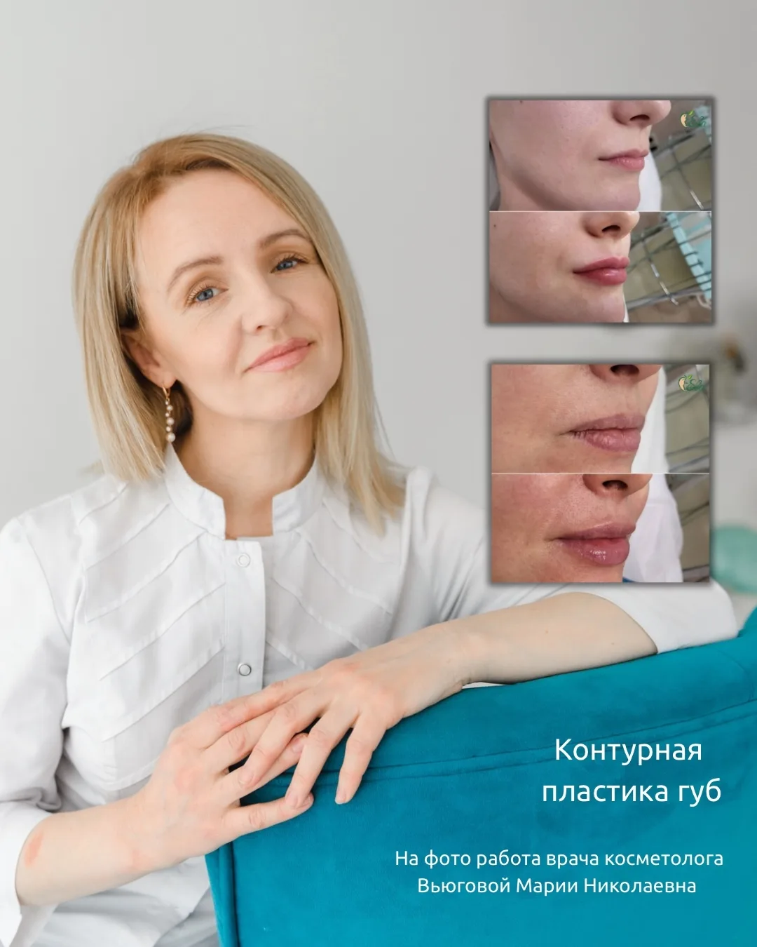 Объём, чёткий контур и эффект свежести — всё это про контурную пластику губ 💋