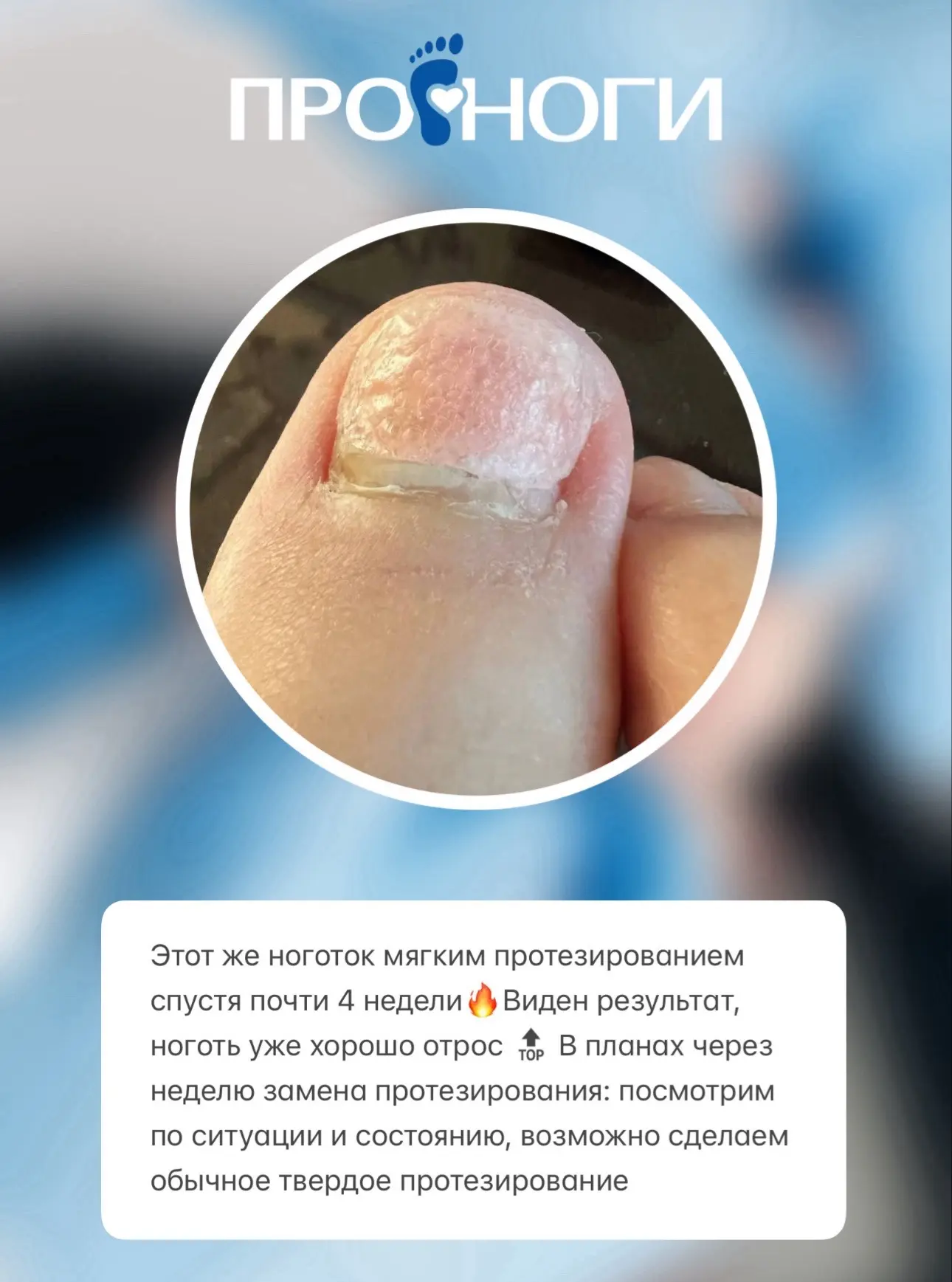 Помните видео выше про мягкое протезирование ногтевой пластины? 

Оцените результат 🔥