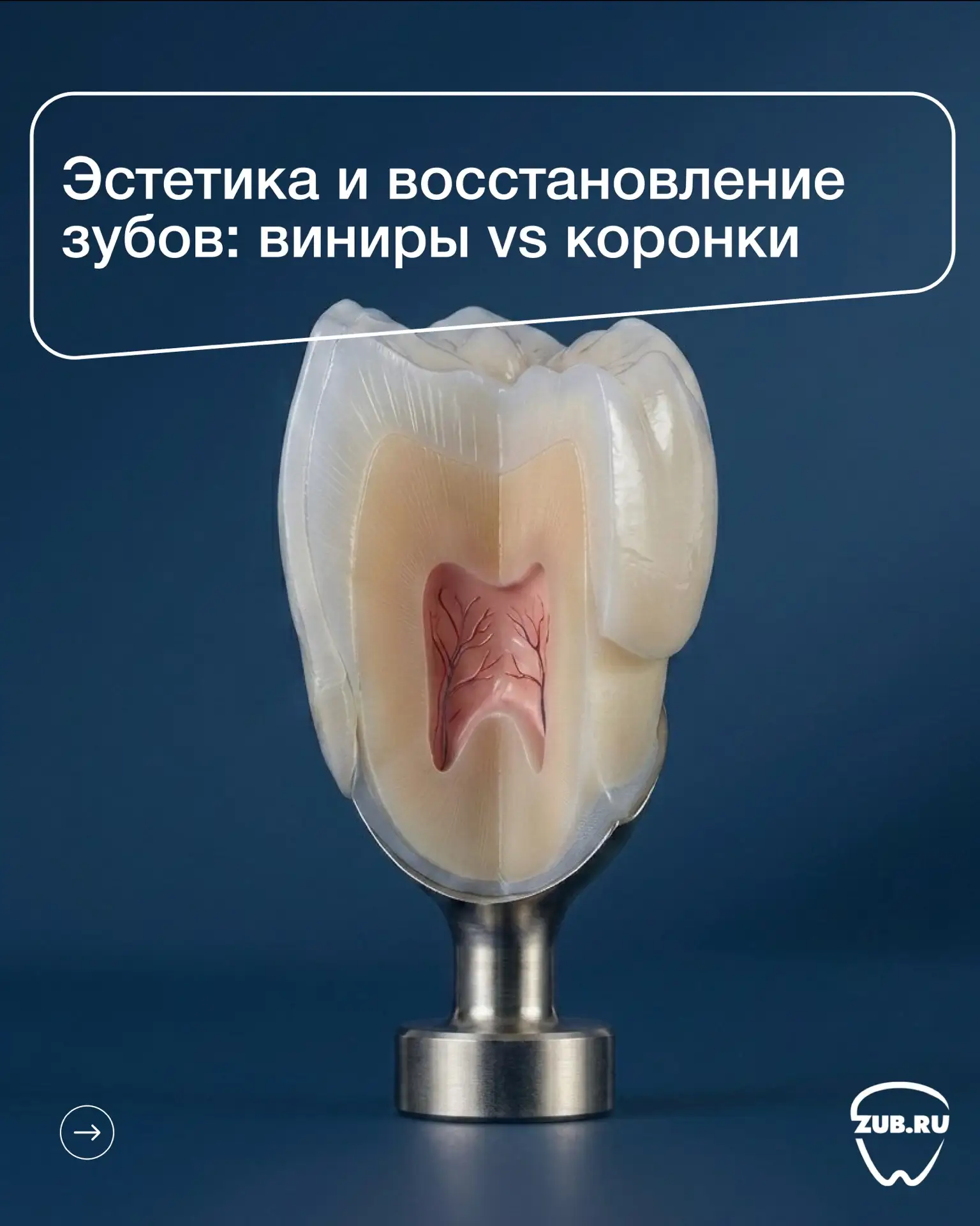 Виниры или коронки: что выбрать для идеальной улыбки?