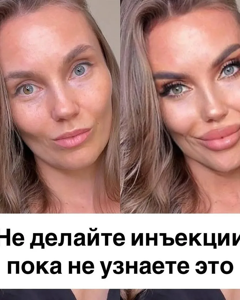 ‼️Инъекции – это не омоложение, это паралич 🙅‍♀‍💉  Заморозить мышцу — не значит вернуть молодость. Э