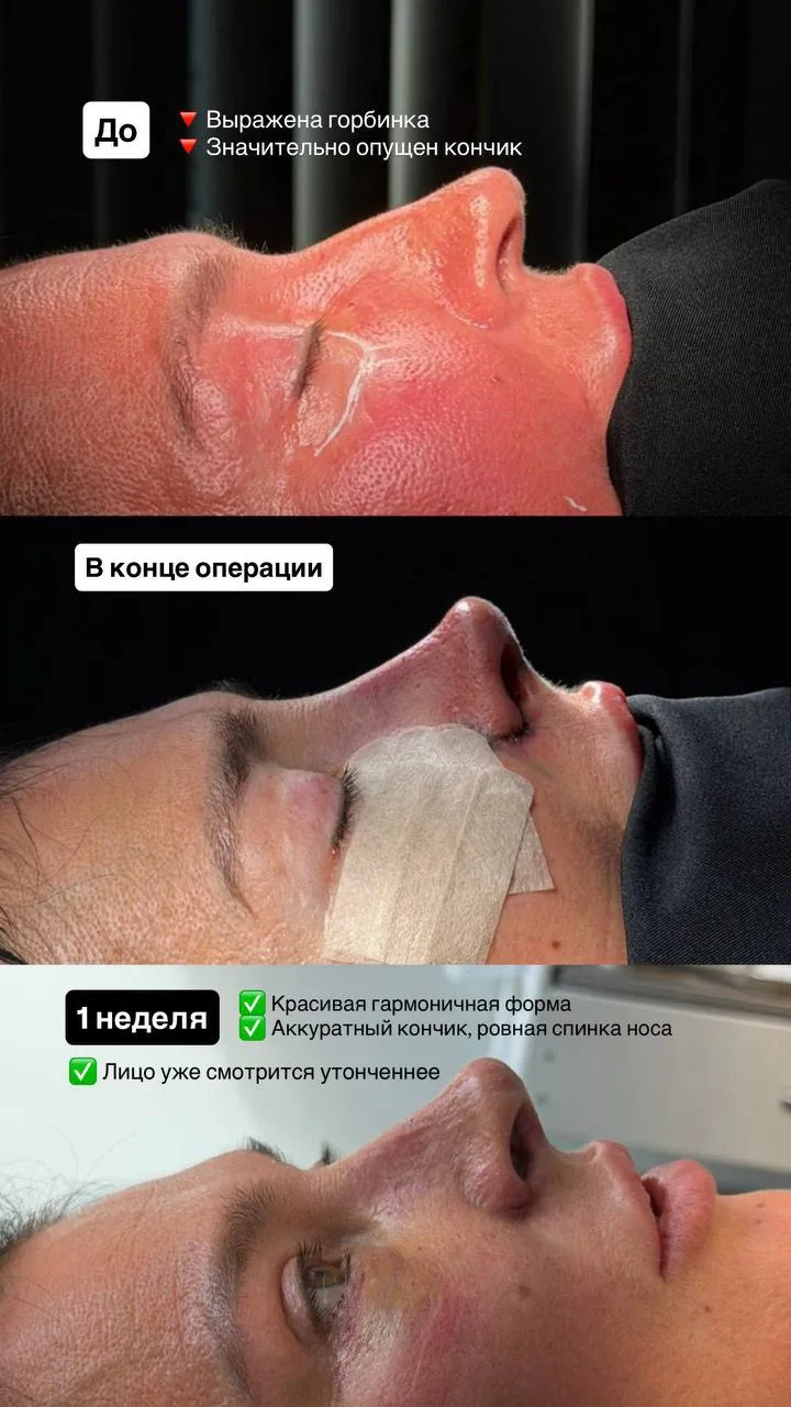 Как меняется нос после ринопластики?